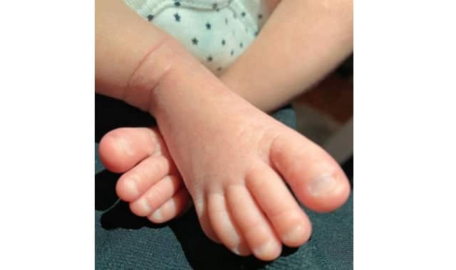 赤ちゃんが足をクロスするのは脳性麻痺？という不安について
